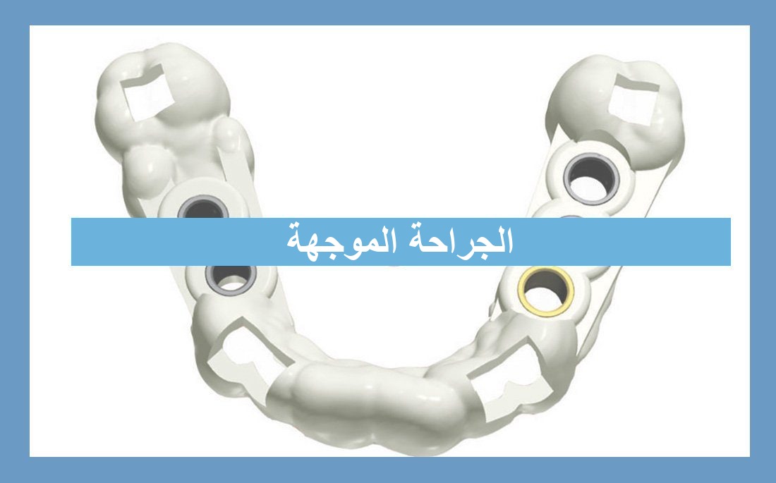 جراحة الزرع الموجهة