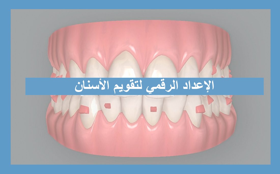 الإعداد الرقمي في تقويم الأسنان