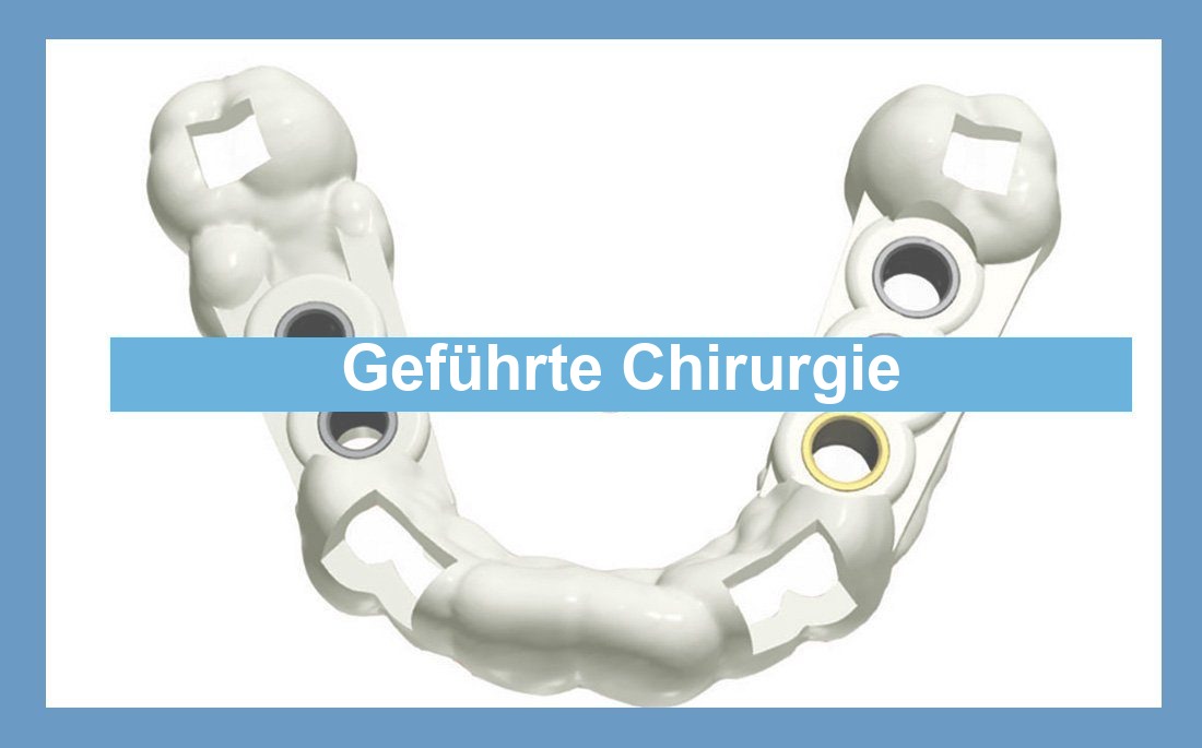 Illustration Artikel geführte Implantatchirurgie