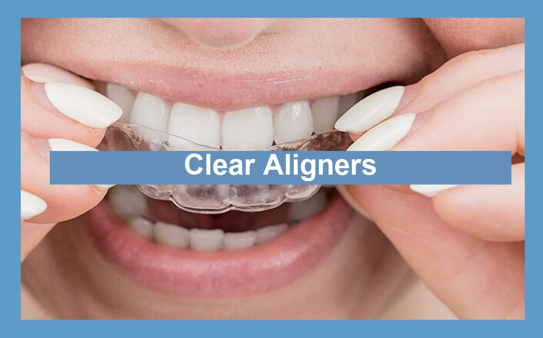 Clear Aligners: Alternative to Conventional Orthodontic Systems