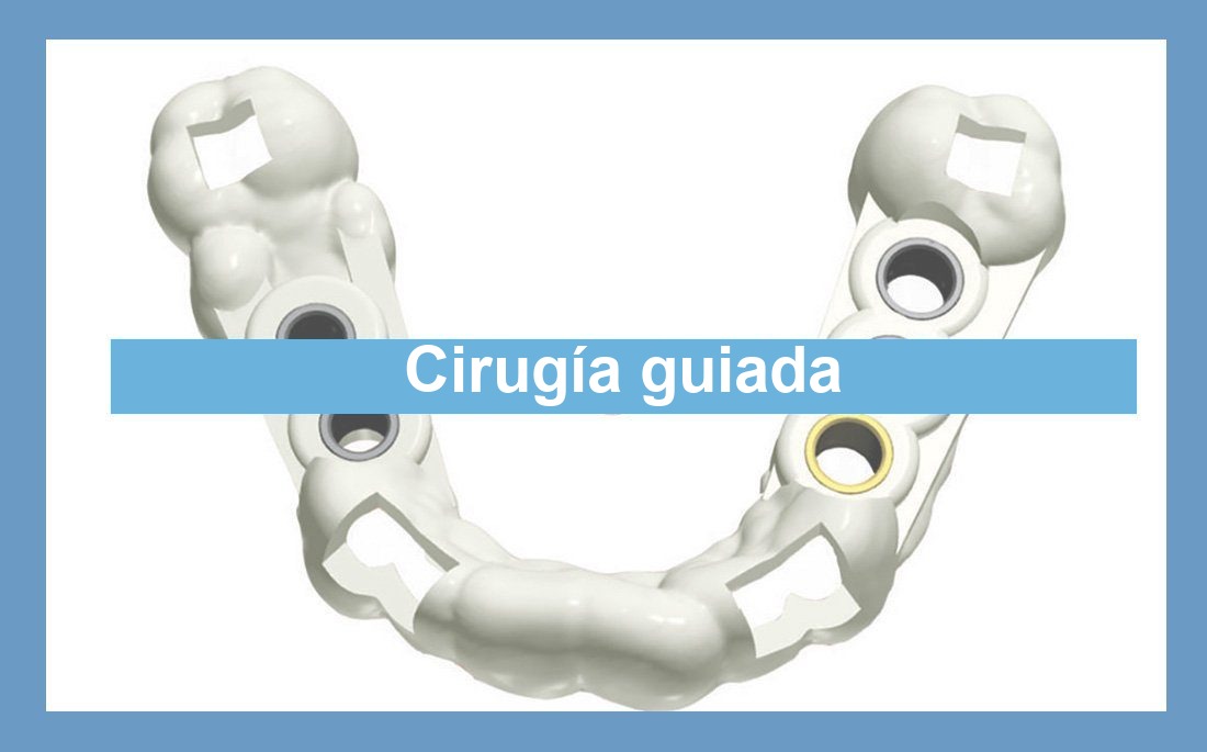 Ilustración artículo cirugía guiada