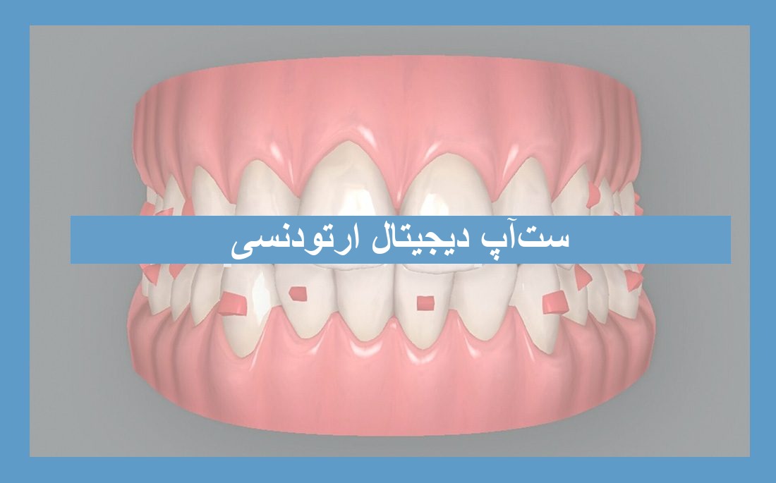 تصویر مقاله Set-Up دیجیتال در ارتودنسی