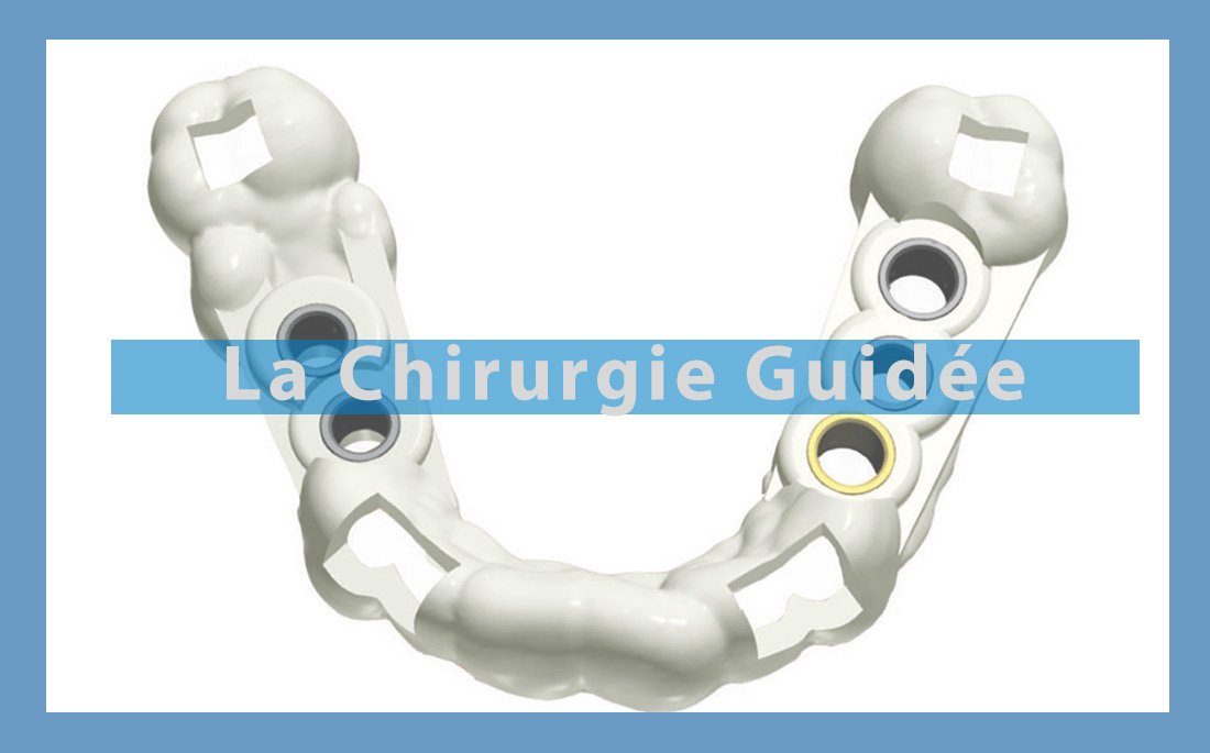 Illustration article la chirurgie guidée