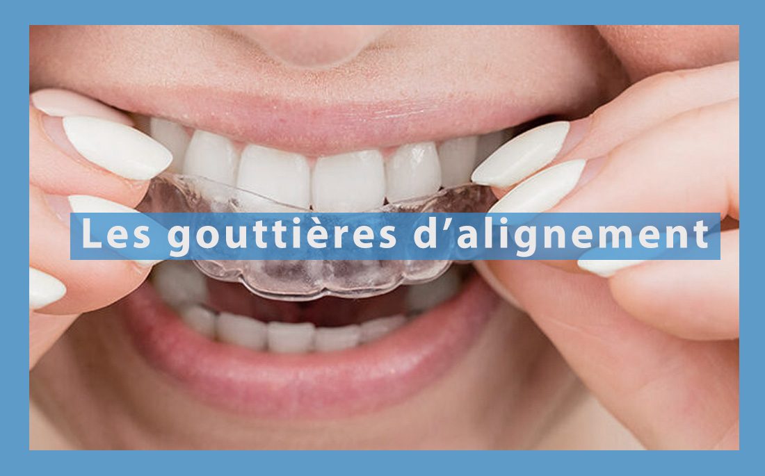 Illustration article les gouttières d'alignement