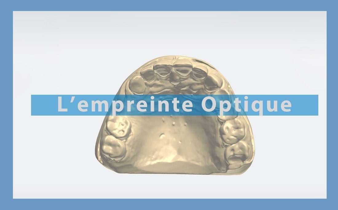 Illustration article empreinte optique dentaire