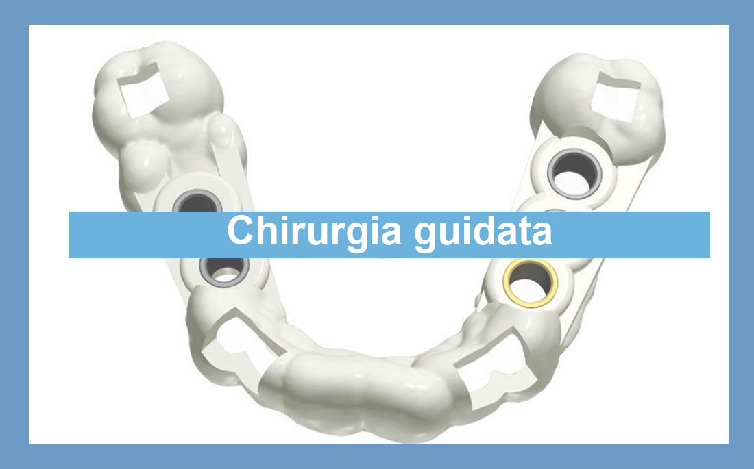 Illustrazione articolo chirurgia guidata