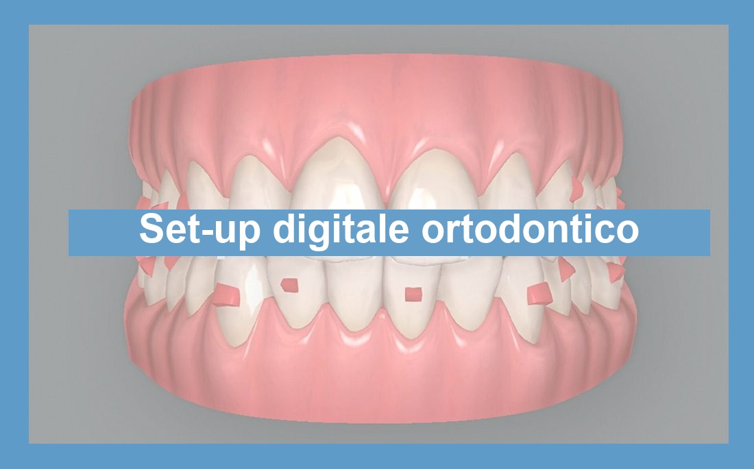 Illustrazione articolo set-up digitale in ortodonzia