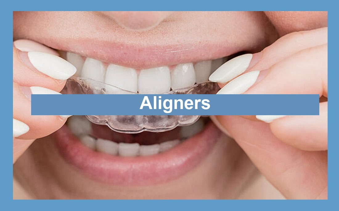 Illustratie aligner-beugels