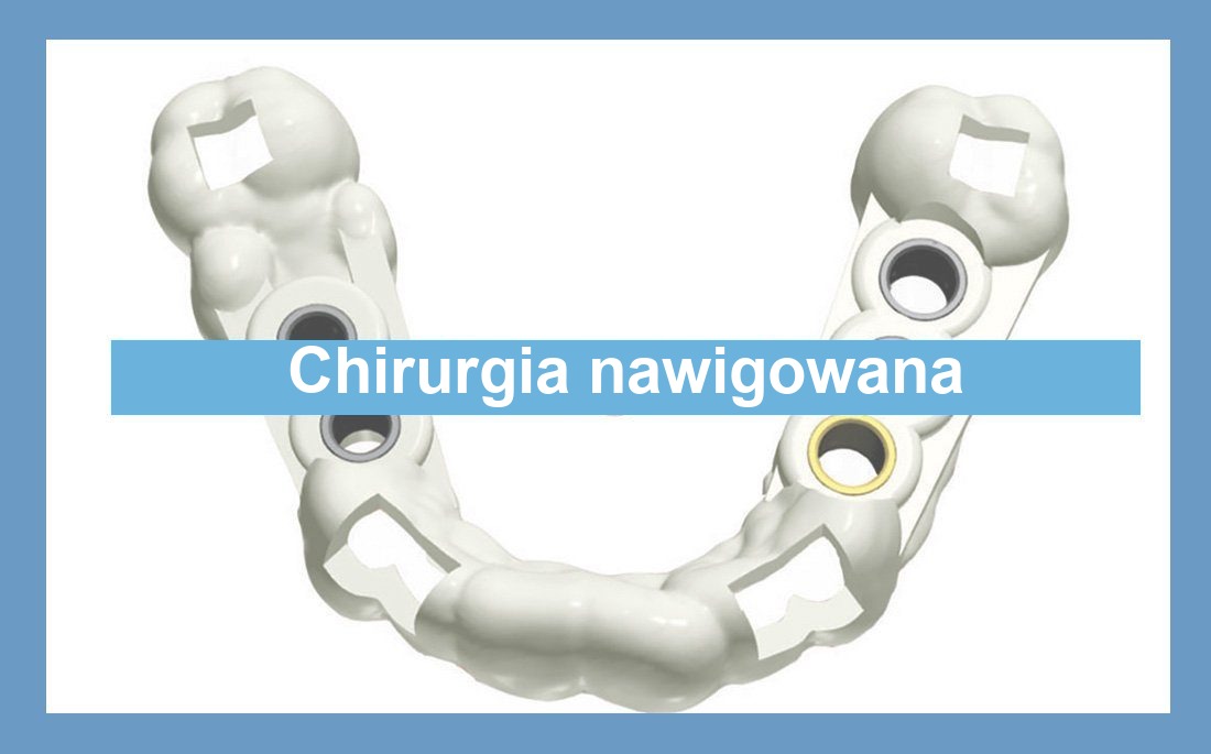 Ilustracja nawigowana chirurgia
