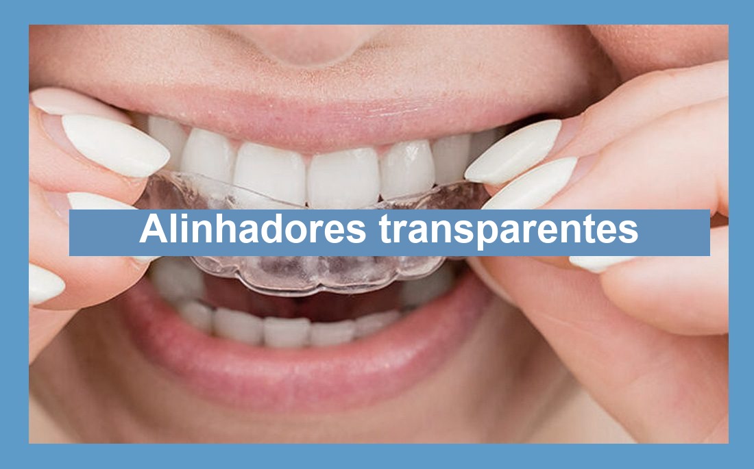 Ilustração artigo alinhadores dentais