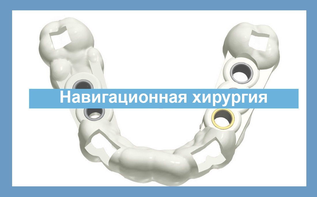 Управляемая имплантологическая хирургия