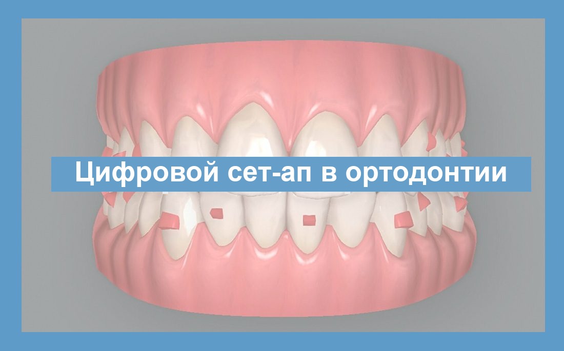 Цифровой Set-Up в ортодонтии