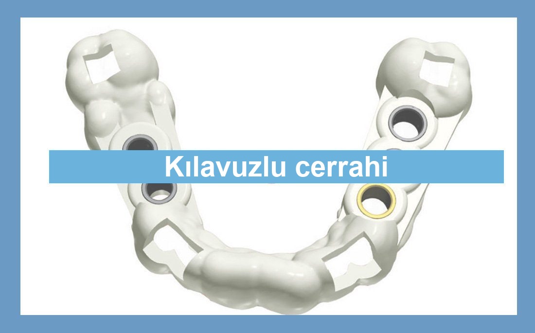 Kılavuzlu cerrahi illüstrasyonu