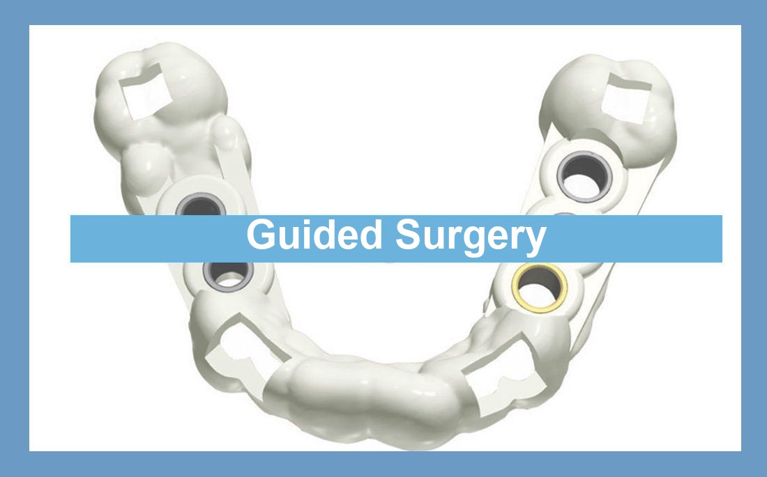 Guided implant surgery