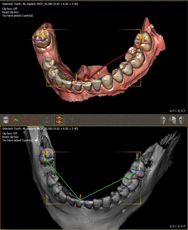 Matching the DICOM and .STL file using QuickVision 3D software