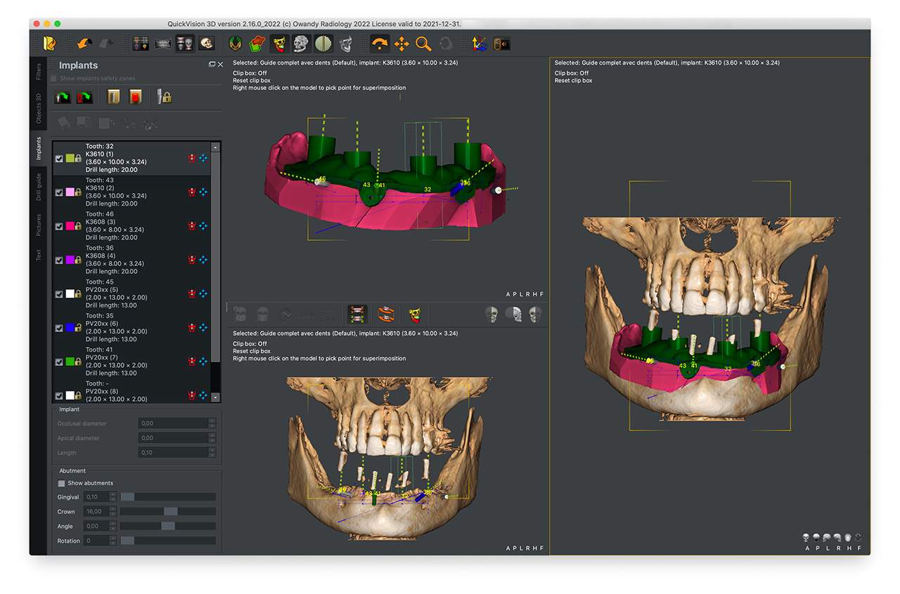 Various sections showing the position of implants on QuickVision 3D planning software