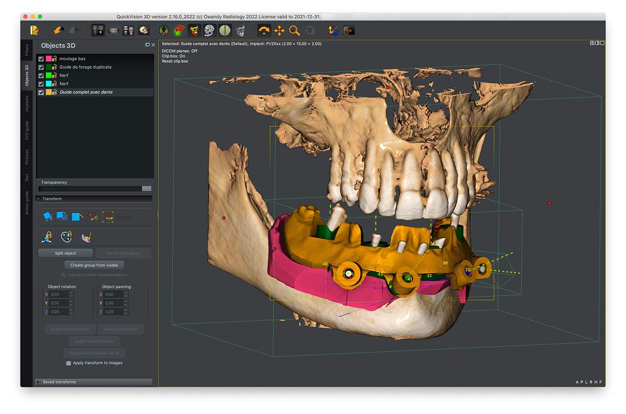 Surgical guide design using QuickVision 3D planning software