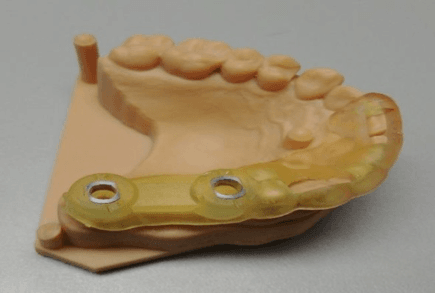 3D printed surgical guide with QuickVision 3D