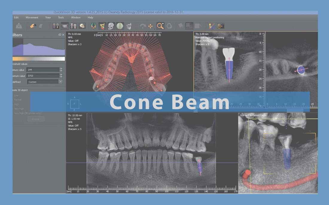Cone beam computed tomography for dental implants surgery