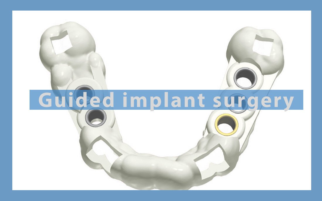 Guided implant surgery