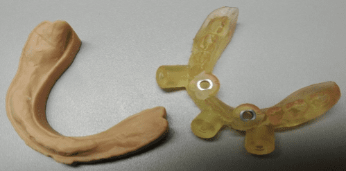3d printed dental implant guide for surgery 