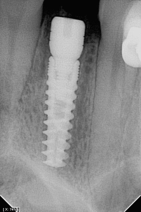ONE Dental Intraoral Sensor - Owandy Radiology